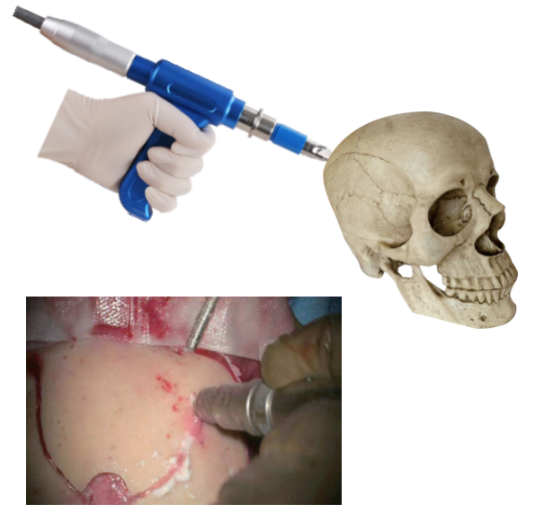 自?？焖匍_顱鉆